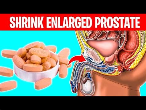 Vitamin To Shrink An Enlarged Prostate Quickly Youtube