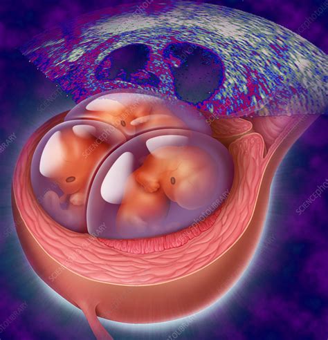 Triplet Fetuses Stock Image C001 5001 Science Photo Library