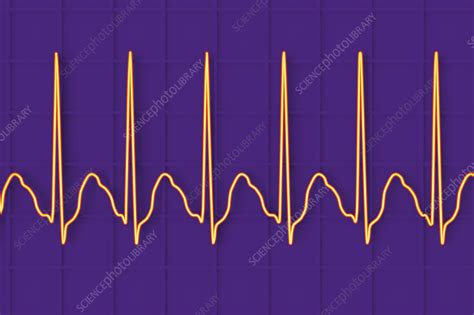 Atrial Flutter Abnormal Heartbeat Rhythm Illustration Stock Image