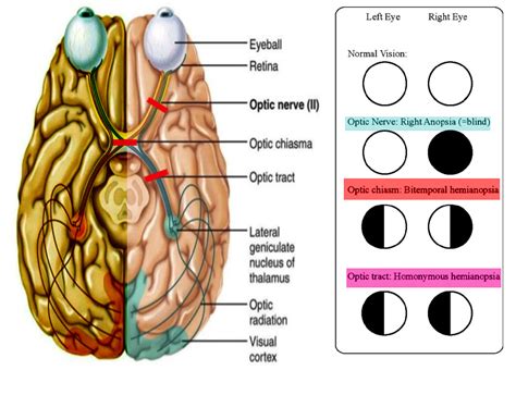 Neuroanatomy Optic Tract Statpearls Ncbi Bookshelf