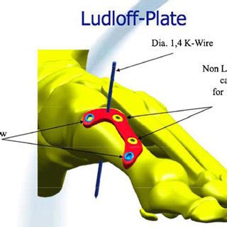 A Low Profile Locking Plate Screw Designed For Fixation Of The Ludloff