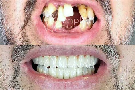 Implante Total Protese Zirconia Antes E Depois 50kb ImplArt