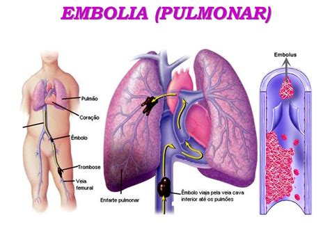 Embolia Pulmonar Co Gulo De Sangre En Los Pulmones Causas S Ntomas