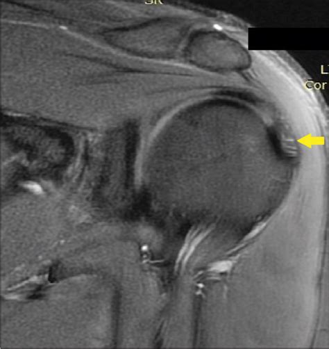 A plane-based approach for the characterization of supraspinatus tendon ...