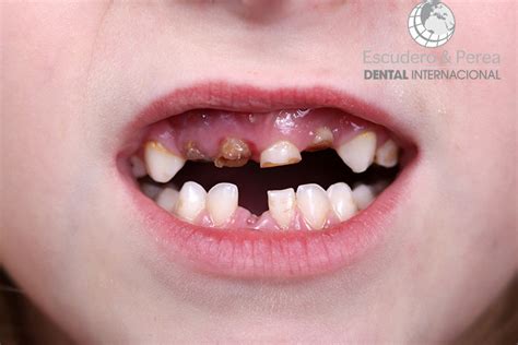 Preguntas Y Respuestas Sobre Odontopediatria Caries Dental En Ni Os