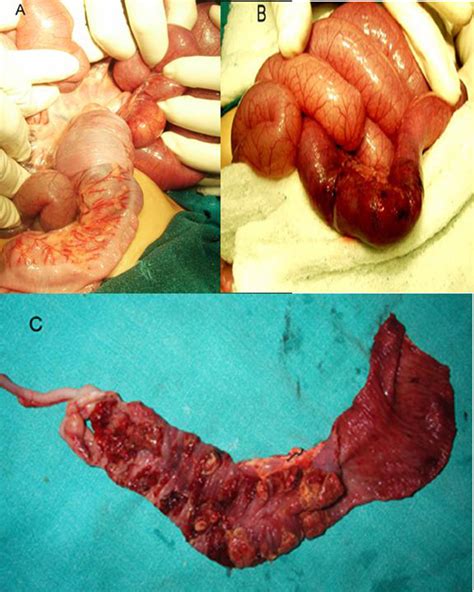 A Photograph Showing The Ileocolic Intussusception B Congested