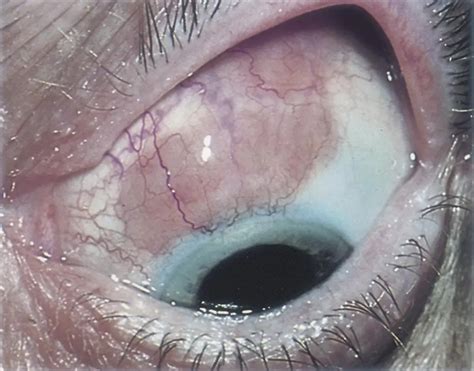Conjunctival lymphoma. - American Academy of Ophthalmology