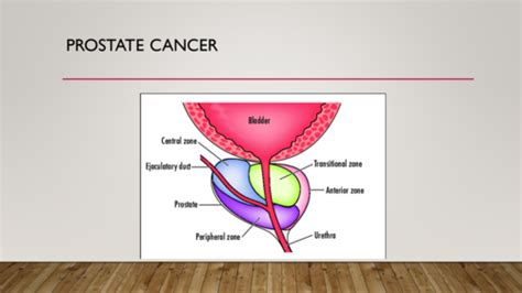 Prostate Cancer Flashcards Quizlet