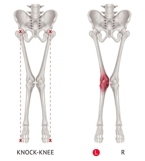 Knee Cartilage Damage Repair Clinic Cartilage Regeneration