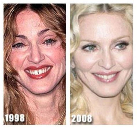 Madonna Plastic Surgery Before And After Facial Cosmetic Surgery