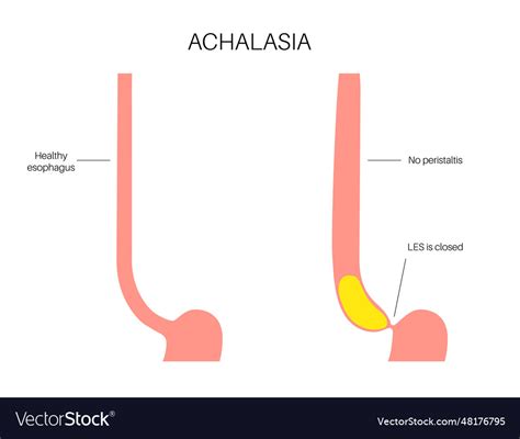 Esophageal Achalasia Disease Royalty Free Vector Image