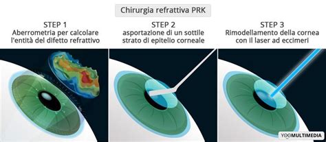 Chirurgia Refrattiva PRK Dr Luca Buzzonetti Oculista Roma