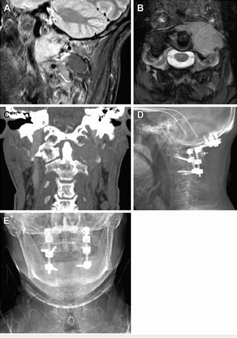 A Man In His Mid 50s Presented With A Bony Lesion Eroding The Left C1 Download Scientific