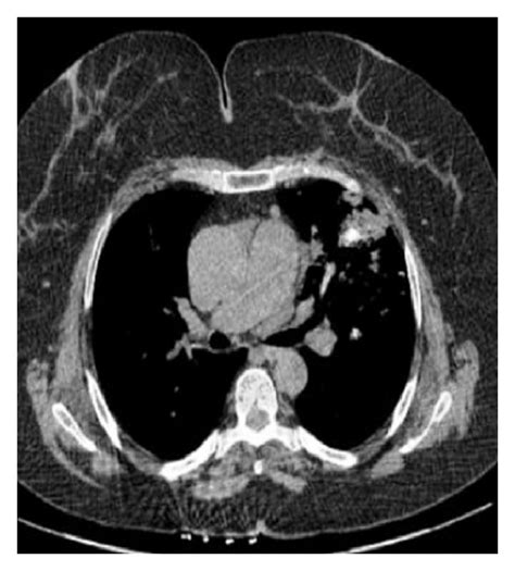 Multiple Calcified Nodules Air Cysts In Both Lungs And Download Scientific Diagram