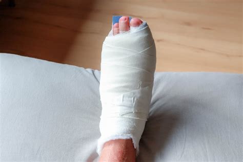 Everything You Need to Know About Bunion Surgery Recovery