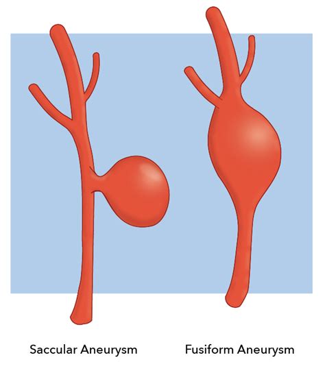 Berry Aneurysm Treatment And Management Point Of Care