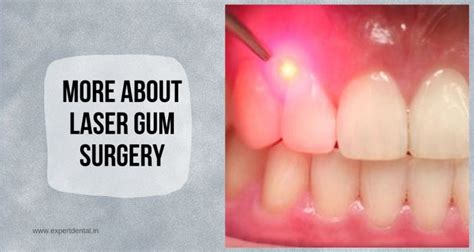 More About Laser Gum Surgery - Expert Dental Care