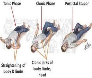 GENERALISED TONIC CLONIC SEIZURES | PPT