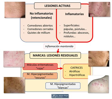 Marcas o cicatrices de acné Dr Adrián Alegre Sánchez Dermatología