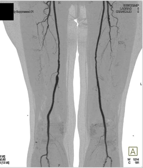 Dual Energy Ct Angiogram With Peripheral Vascular Disease In Sfa