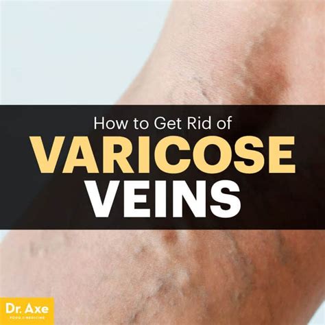 How To Get Rid Of Varicose Veins 5 Natural Remedies Dr Axe