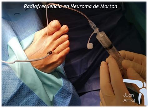 Neuroma De Morton Juan Arnal Traumatologo En Madrid