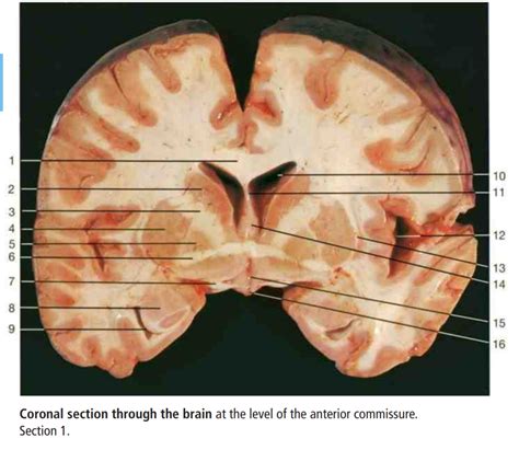 Brain Coronal Section At Anterior Commissure Diagram Quizlet