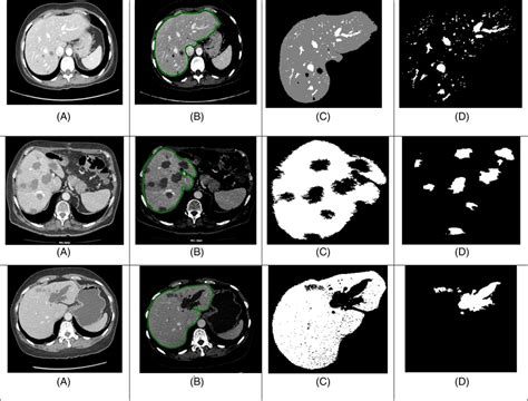 Liver Tumors Segmentation Results For Three Cases A Original Images