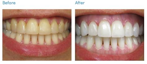 Your Blog - Best Whitening Teeth Dental Care