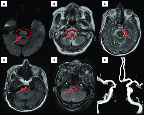 Basilar Artery Mri