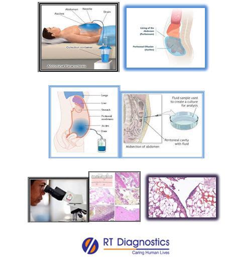 Cytology - Peritoneal Fluid | RT Diagnostics