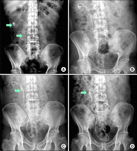 Kidney Stones Xray