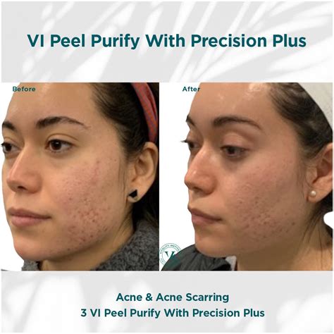 VI Peel Before After Photos Women First LLC