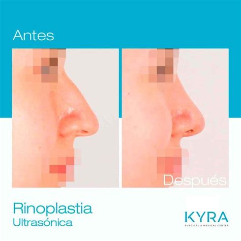 Dr Francisco Solesio mejor cirujano en rinoplastia ultrasónica alicante