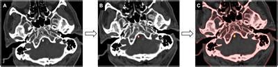 Frontiers Ct Texture Analysis Of Vertebrobasilar Artery Calcification