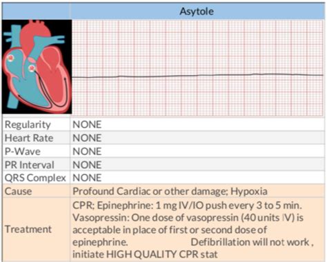 Ekg Strips Flashcards Quizlet