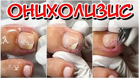 ОНихолизис / Зачистка / Зачистка Онихолизиса / Скрученный ноготь ...