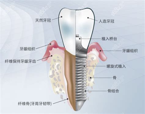 韩国迪奥种植牙多少钱一颗dio种植牙价格3680元能搞定吗种植牙 8682整形网
