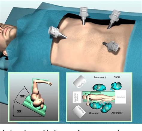 Figure From Transperitoneal Laparoscopic Adrenalectomy Outline Of