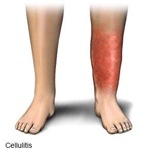 Cellulitis (Aftercare Instructions)