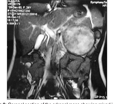 Figure 2 From A Case Series Of Two Cases Of Juxta Adrenal Schwannoma