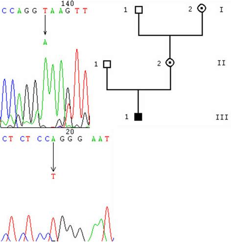 splice site mutations. 5A: chromatogram of the 547+2T->A mutation, from ...