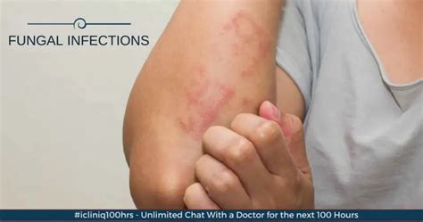 Fungal Infections Of The Skin Symptoms Causes And