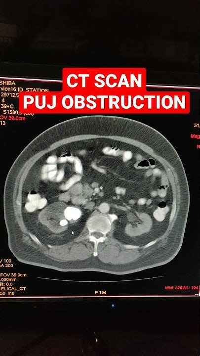 What Is Puj Obstruction Ct Scan For Puj Obstruction Youtube