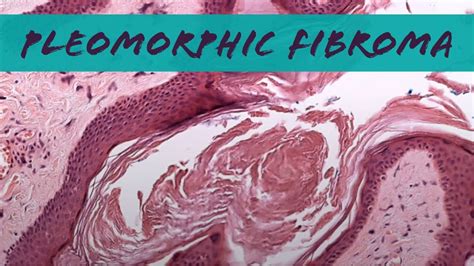 Acrochordon Histology