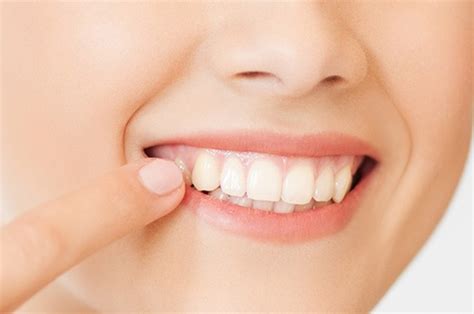 Retenedores dentales qué son e importancia tras la ortodoncia