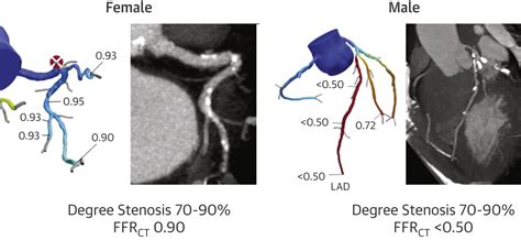 Sex Differences In Coronary Computed Tomography Angiographyderived