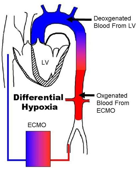 Va Ecmo — Learnecmo