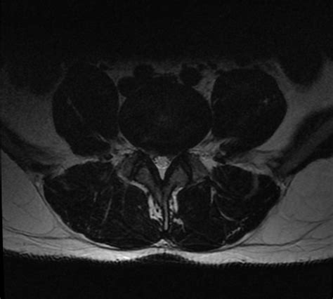 L5 nerve root compression caused by facets, protrusion or both? : r/Sciatica