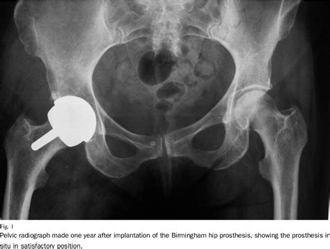 Figure 1 From Inflammatory Pseudotumor Associated With Femoral Nerve Palsy Following Metal On